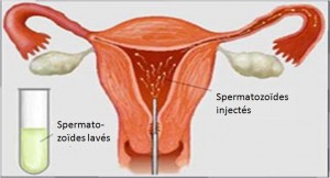 Insémination intra-utérine artificielle (IUI)