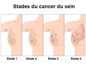 Stades du cancer du sein