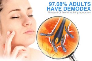 Démodex chez les femmes