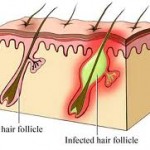 Bumps on bikini area