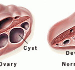 Polycystic ovaries