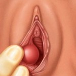 Bartholin cyst