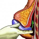 Breast implant