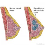 Breast cysts