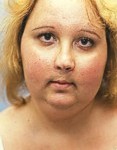 Cushing's disease