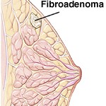 Breast fibroadenoma