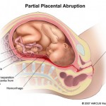 Partial Placental Abruption