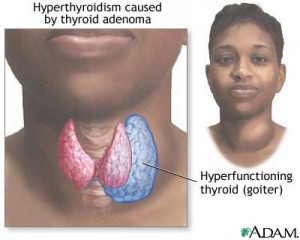 Thyroid hormones and Hyperthyroidism