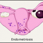 Chocolate cyst - Ovarian endometriosis