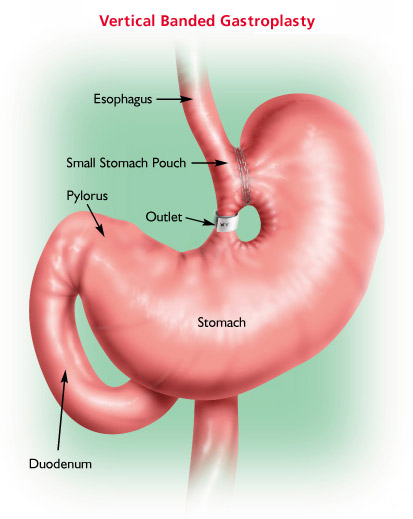 Obesity surgery