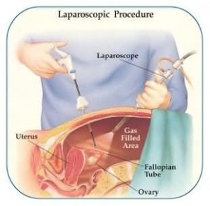 Infertility treatments - Laparoscopy