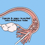 Gamete Intrafallopian Transfer (GIFT)