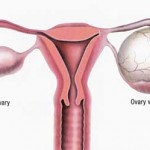 Ovarian cyst