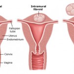 Fibroids
