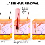 Laser hair removal