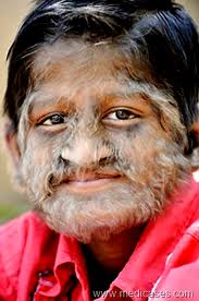 Hypertrichosis