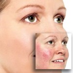 Rosacea treatment