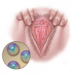 Blisters on vagina - Vaginal Herpes
