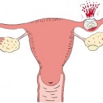 Ectopic tubal pregnancy