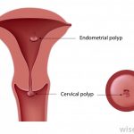 Cervical and uterine polyps