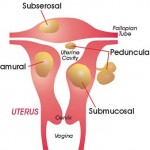 Fibroids