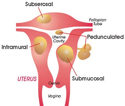 Fibroids