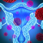 Fibroids treatment