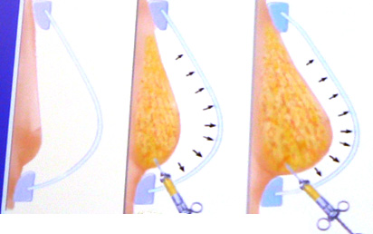 Breast lipofilling