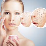Dry skin - Vitamin E deficiency