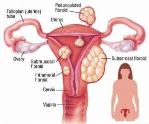 Uterine fibroids