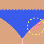 Bikini pimples