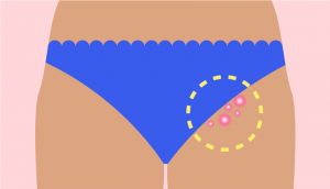 Bikini pimples