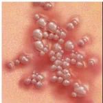 Vaginal herpes