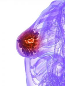 Breast lumps