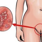 Recurrent genital herpes