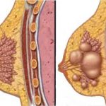 Breast cyst