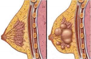 Breast cyst