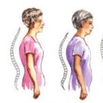 Osteoporosis in women