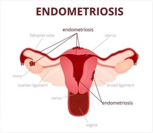 Endometriosis brown discharge