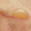 Pustules vaginales