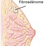 FIBROADENOME du SEIN