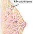 Fibroadénome du sein