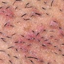 Boutons sur le bikini