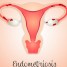 Endométriose causes
