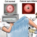 EXAMEN PELVIEN - Le frottis