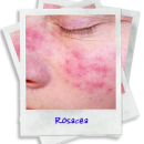 ROSACÉE