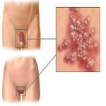 Papillomavirus