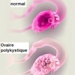 Syndrome Ovarien Polykystique