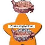 Le syndrome ovarien polykystique