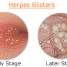 Pustules vaginales : Symptômes